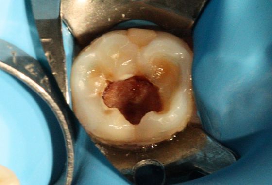 Endodoncia antes