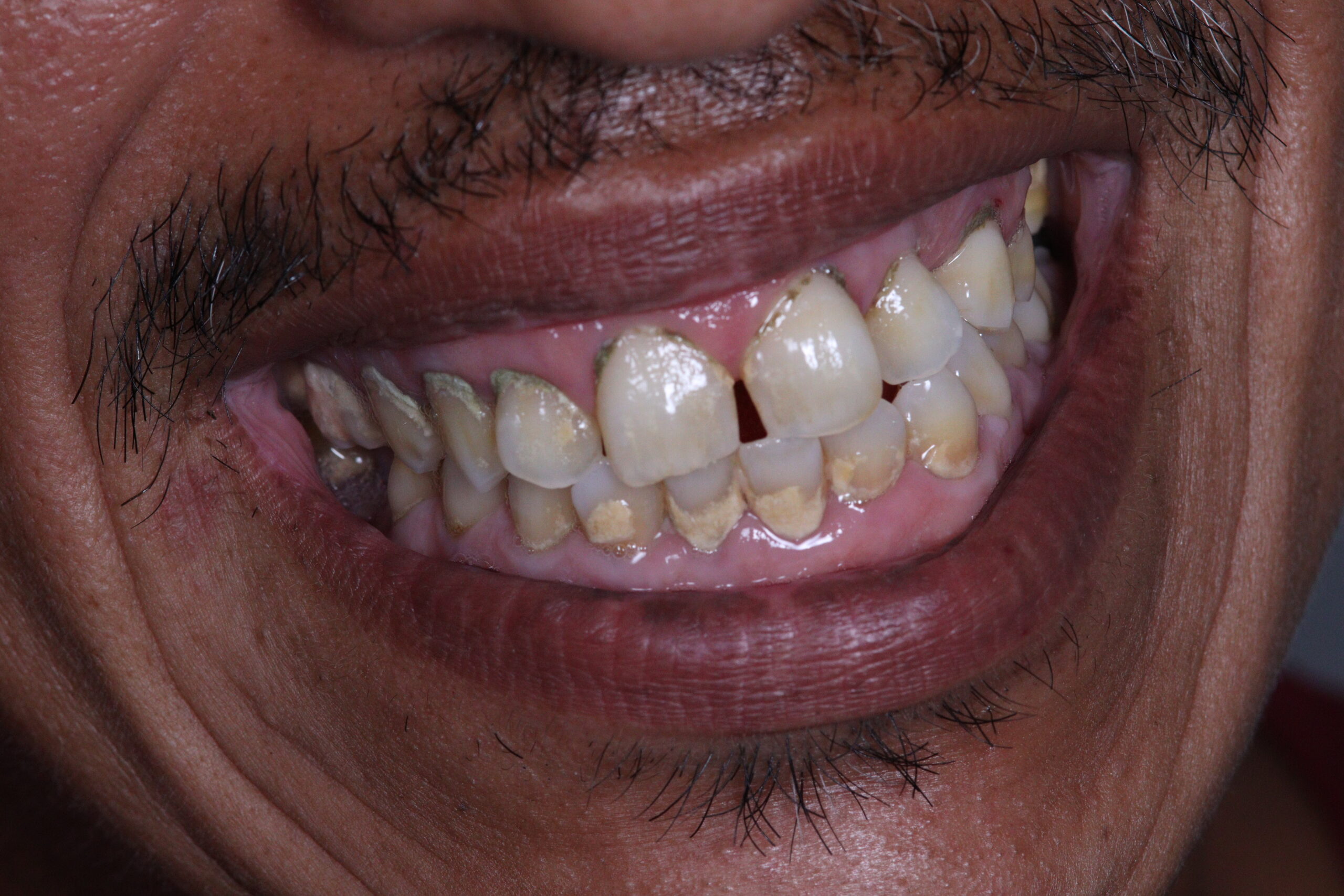 Limpieza dental antes