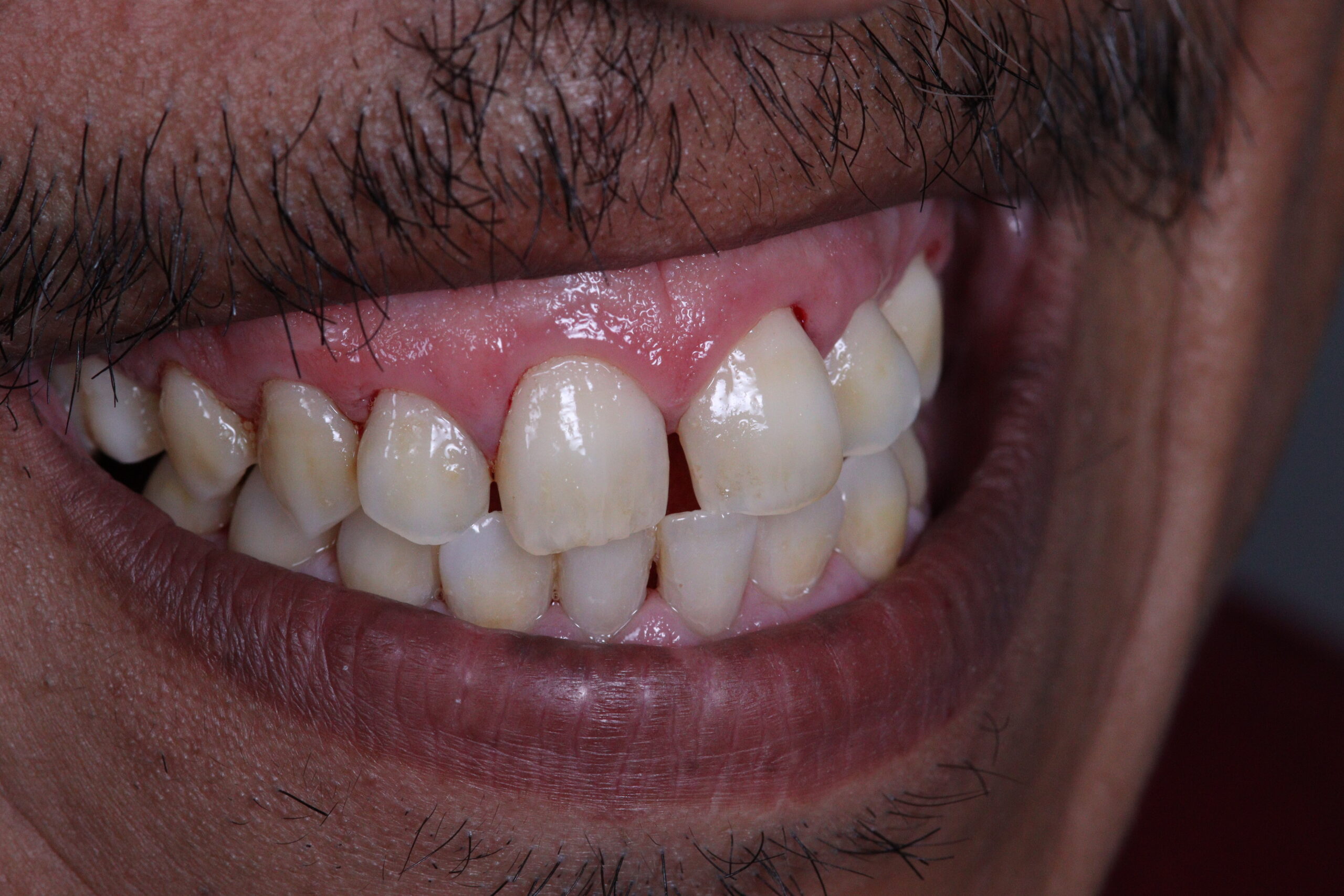 Limpieza dental despues