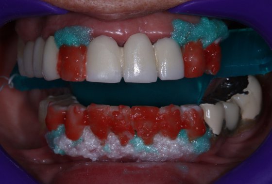 blanqueamiento dental (2)