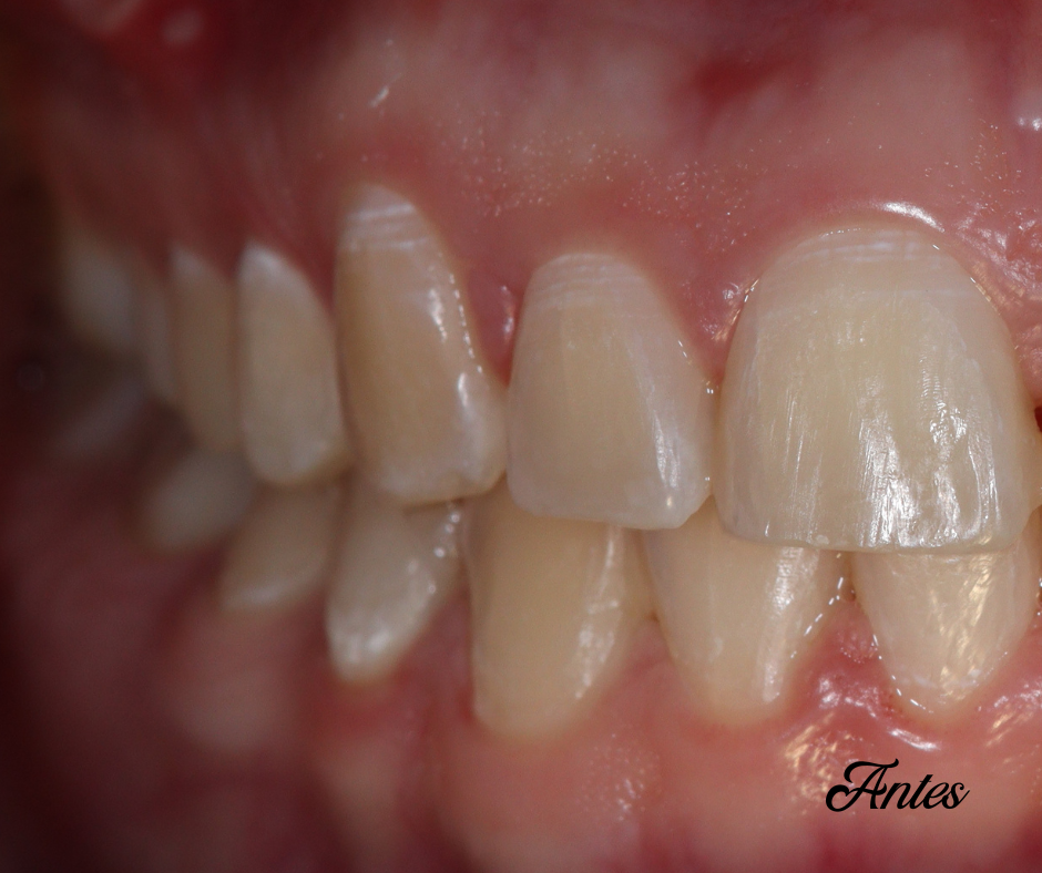 blanqueamiento dental antes