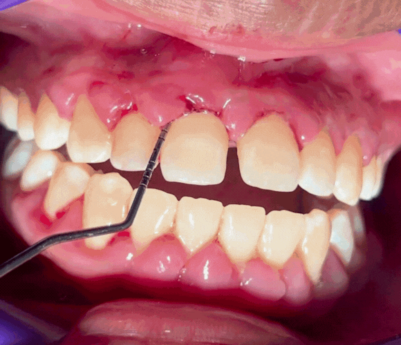 bolsa periodontal (5)