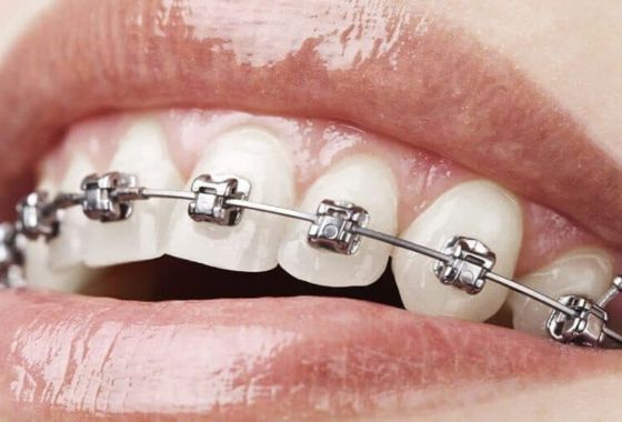 brackets autoligados (1)