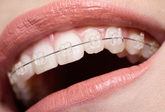 brackets esteticos