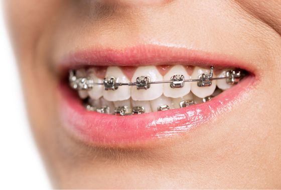 brackets metalicos