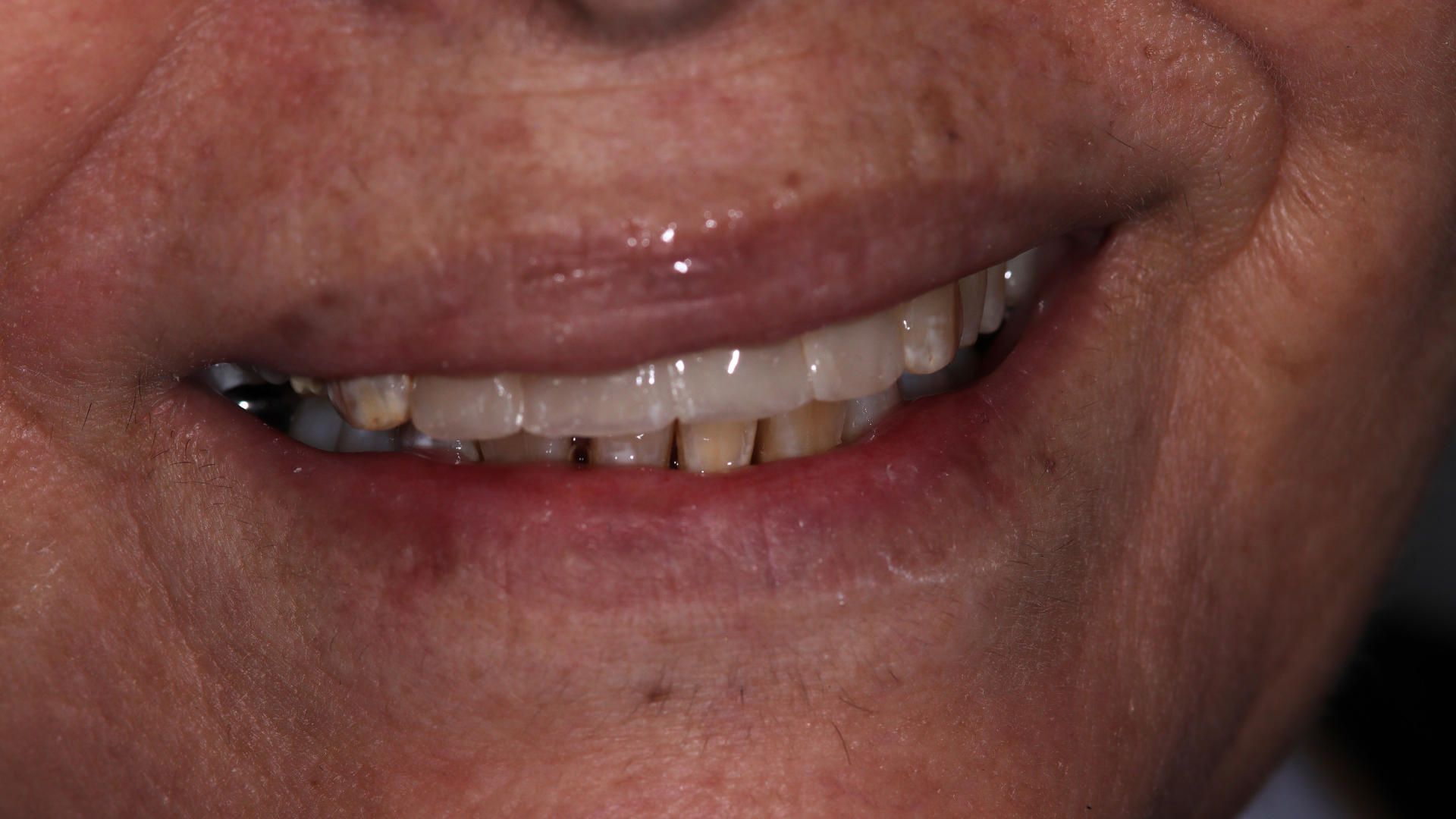 carillas dentales despues