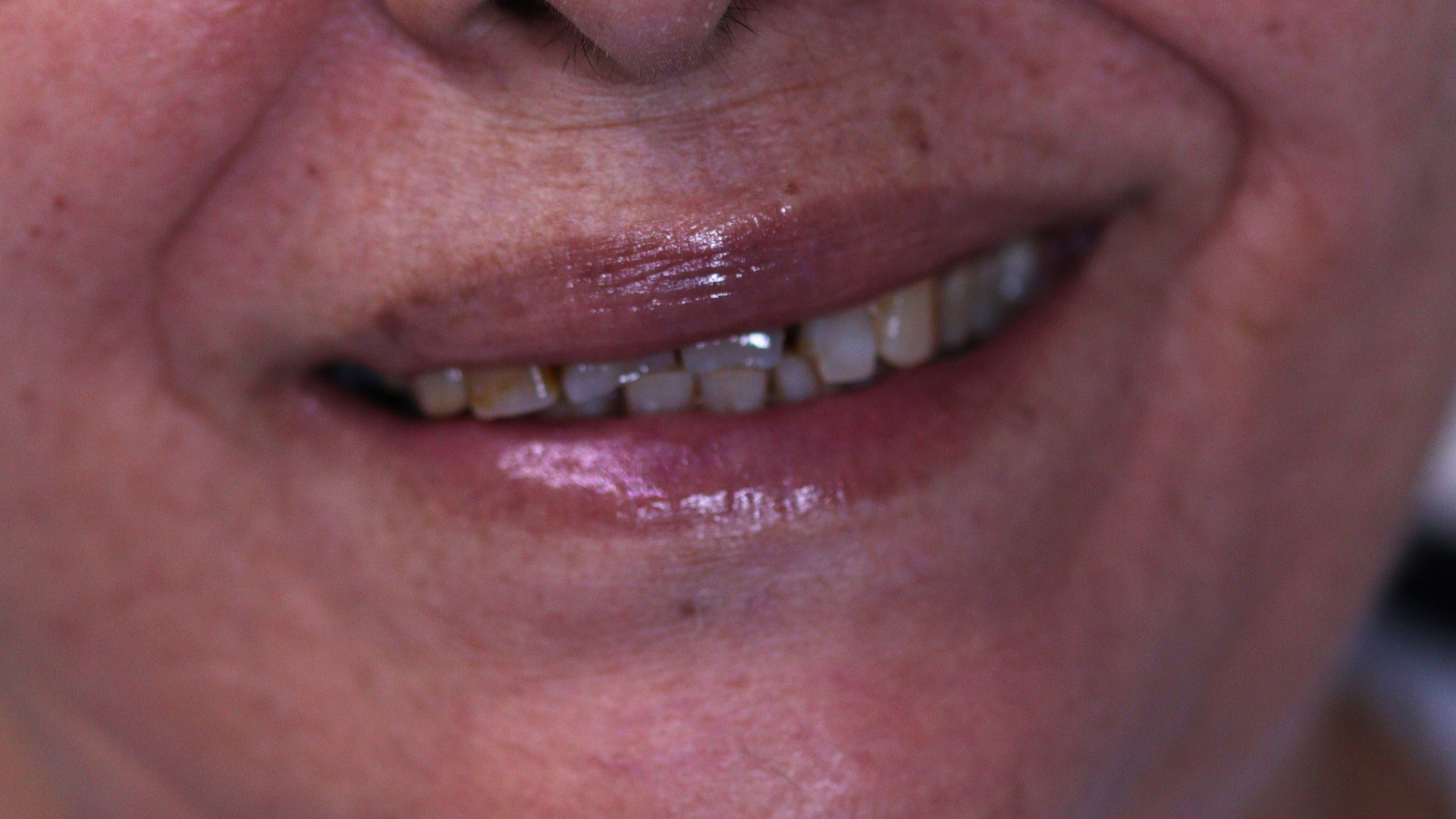 carrillas dentales antes