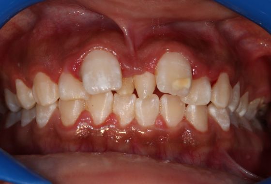 caso de ortodoncia antes