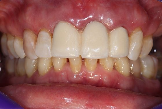 caso puente después