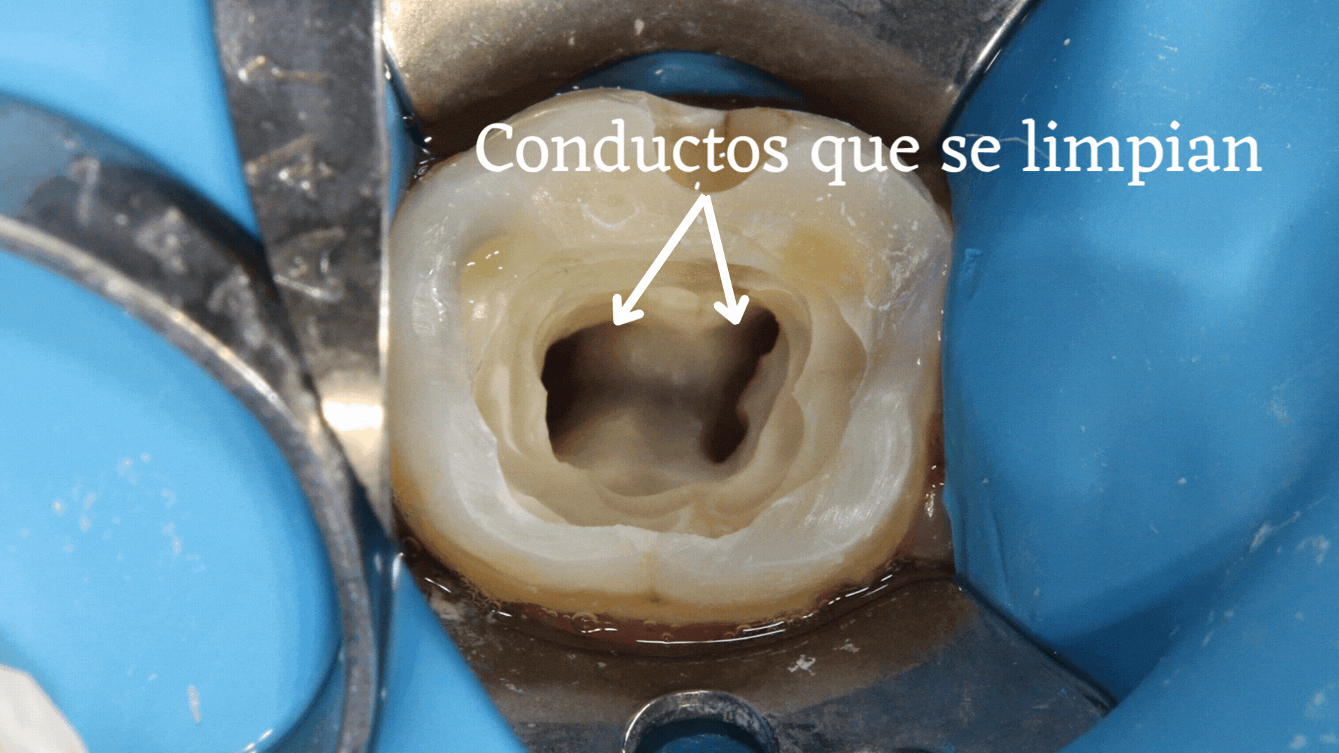 conductos dentales