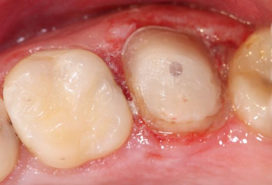 corona dental antes