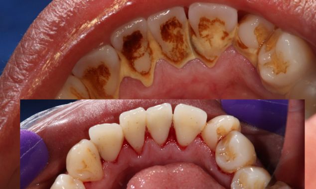 corona dental después