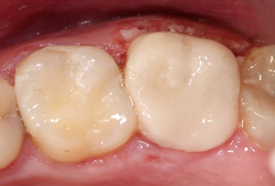 corona dental después