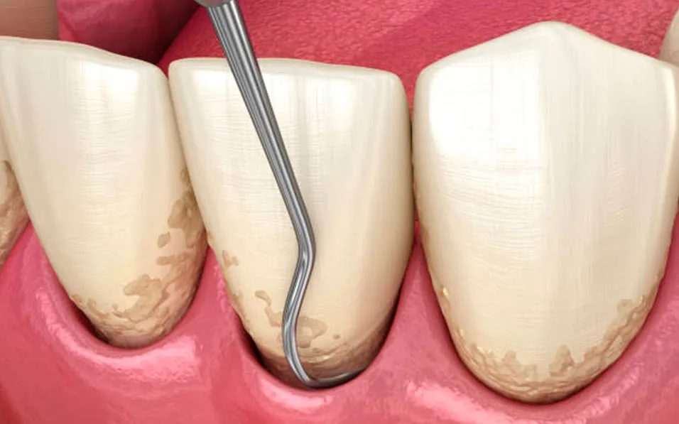 curetaje dental