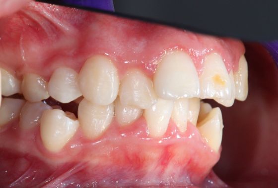 malposición dental (1)