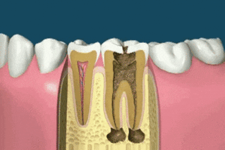 pasos de la endodoncia