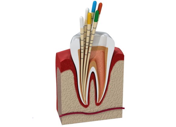 Endodoncia